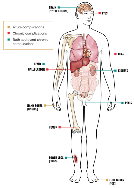 Areas of the body potentially impacted by acute and chronic sickle cell complications