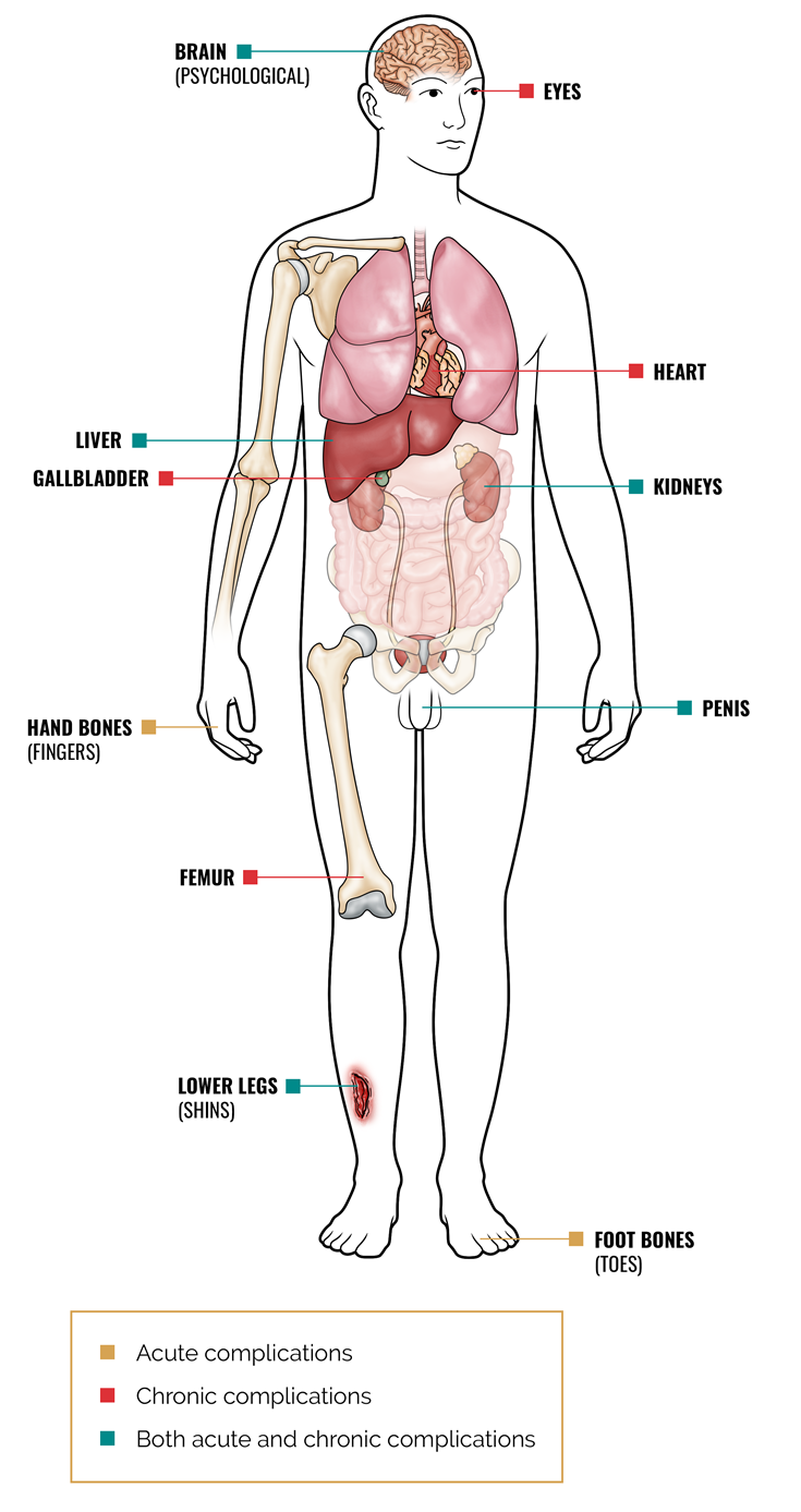 symptoms of sickle cell