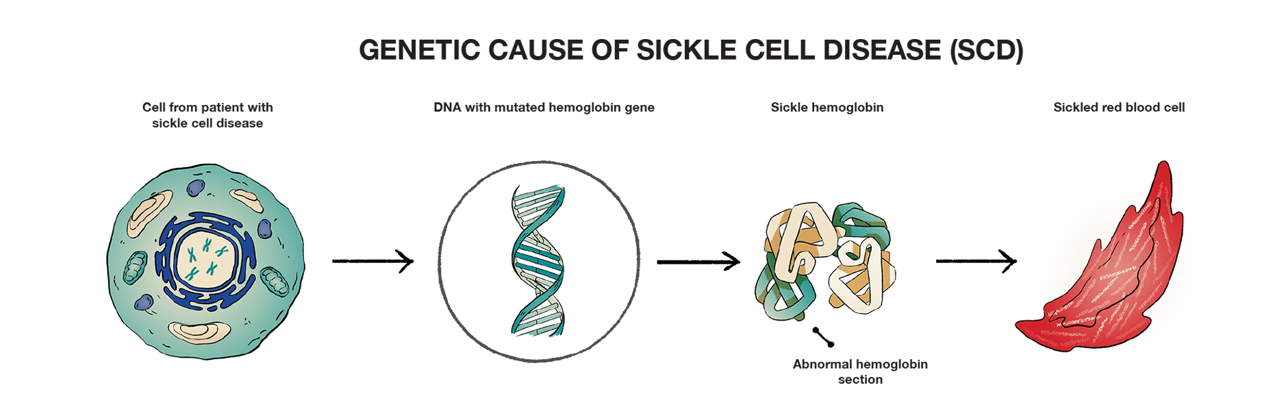 Genetic causes of sickle cell disease