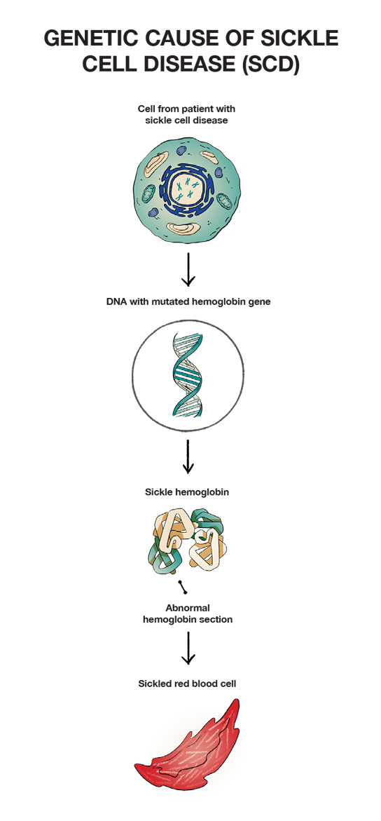Genetic causes of sickle cell disease